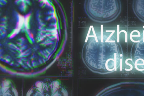Pain in a Senior With Late-Stage Alzheimers
