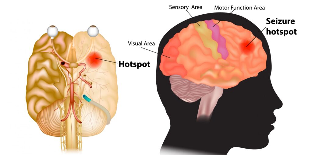 can alzheimers cause seizures