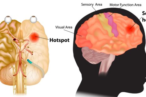 can alzheimers cause seizures